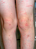 Scratched Legs