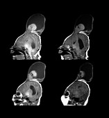 Neonatal MRI of Meningo-encephalocele