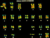 Coloured LM of karyotype of Down's Syndrome female