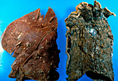 Gross specimen of normal & smoker's lungs