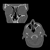 CT of Nasal Septum
