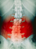 Back pain X-ray