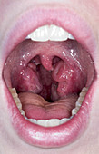 Streptococcal Throat Infection