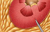 Renal Biopsy