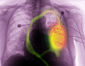 Pacemaker Defibrillator