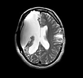 MRI shows near total hemispherectomy