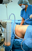 Liposuction cosmetic surgery