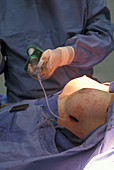 Breast Implant Surgery