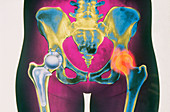 Artwork showing an artificial hip joint in place