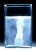 Antacid tablet dissolving in glass of water