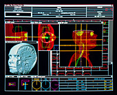 Computer simulation used to plan radiotherapy