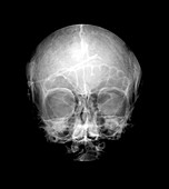 Frontal View of the Skull With a Catheter