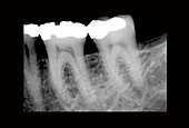 X-ray of Teeth for Root Canal