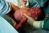 Childbirth: baby being born in hospital