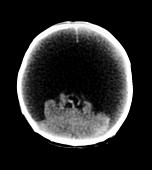 CT of In Utero Brain Damage