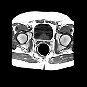 Enlarged Prostate Gland