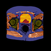 CT Cross Section of Enlarged Prostate