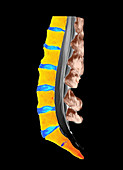 MRI of normal lumbar vertebrae