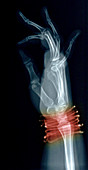 X-Ray of Girls Hand With Bracelets