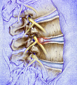 Intervertebral disk