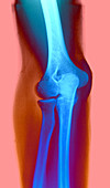 Normal Frontal View of the Elbow