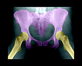 X-Ray of pelvis area
