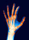 X-Ray of a Normal Female Hand