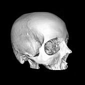 CT Reconstruction of Skull