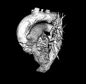 CT (CAT) Scan of the Chest