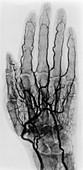 Hand Arteriogram