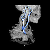 colour Enhanced 3D CTA of Carotid Arteries