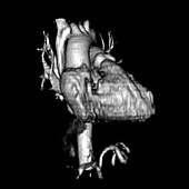 3D CTA of Heart