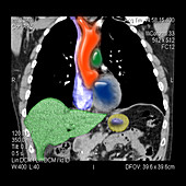 CT of the Chest