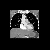 Normal Pulmonary Arteries