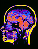 F/colour MRI scan of the human head (side view)