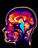 MRI scan of human brain with brainstem highlighted