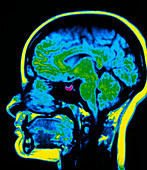MRI scan of a healthy human brain