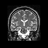 Coronal Cross Sectional MRI of the Brain
