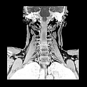 Coronal MRI of Brachial Plexus