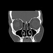 CT of Paranasal Sinuses