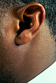 Genetic trait: attached earlobe