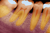 colourized dental x-ray