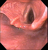 Larynx and Vocal Cords