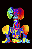 Frontal x-ray from an IVP