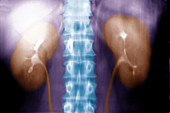 Intravenous pyelogram of the kidneys