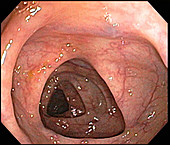 Transverse Colon