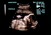 Ultrasound of a foetus in profile (23 weeks)