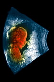 Foetus,ultrasound scan