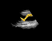 Ultrasound of foetus leg and foot