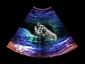 foetal Foot